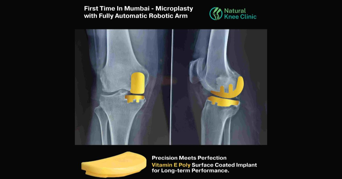 Medical Breakthrough: Preserve Your Natural Knee with Absolute Precision Robotic Microplasty Surgical Technique